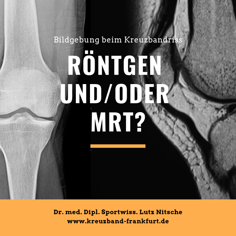 Röntgen und/oder MRT bei der Diagnose Kreuzbandriss? | Kreuzband-Frankfurt